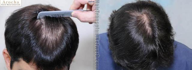 Top view before and after hair restoration results