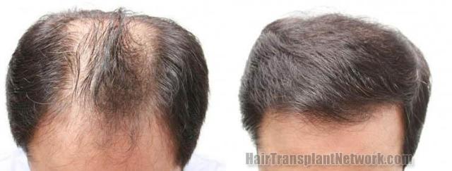 Top view before and after hair restoration results