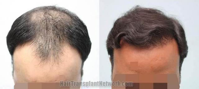 Top view before and after hair restoration results