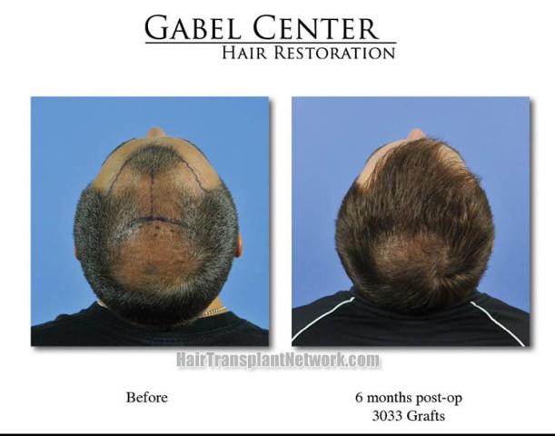 Back view before and after hair transplantation photos