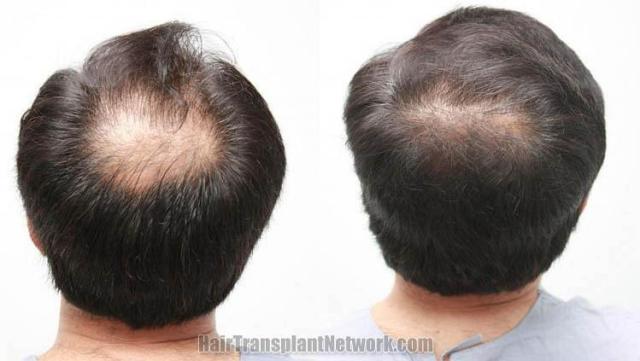 Back view before and after hair transplantation photos