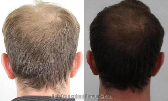 Hair transplantation surgery before and after pictures