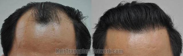 Hair restoration procedure before and after results