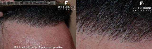 After photos of hair transplant surgery hairline closeups