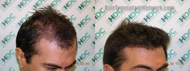 Hair restoration procedure before and after pictures