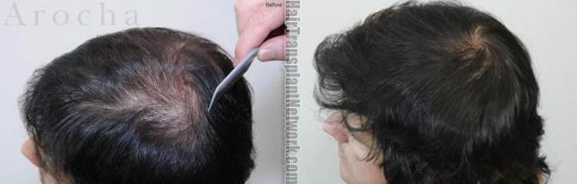 Hair transplantation surgery before and after photos