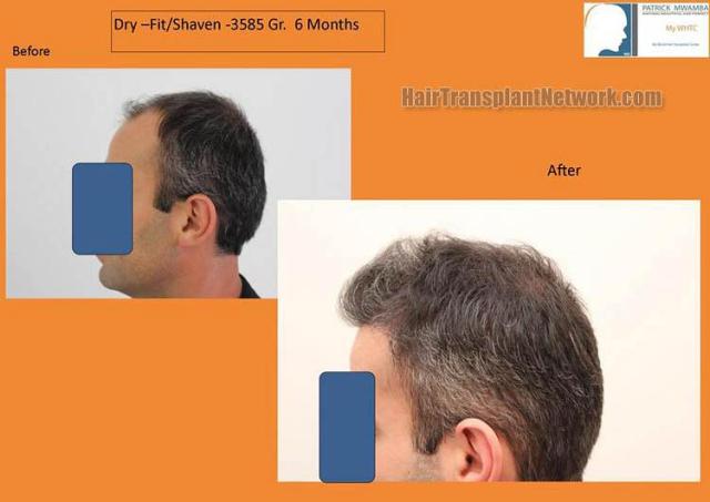 Hair restoration procedure before and after pictures