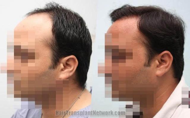 Hair transplantation surgery before and after pictures