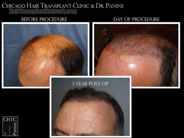 Hair transplantation surgery before and after images