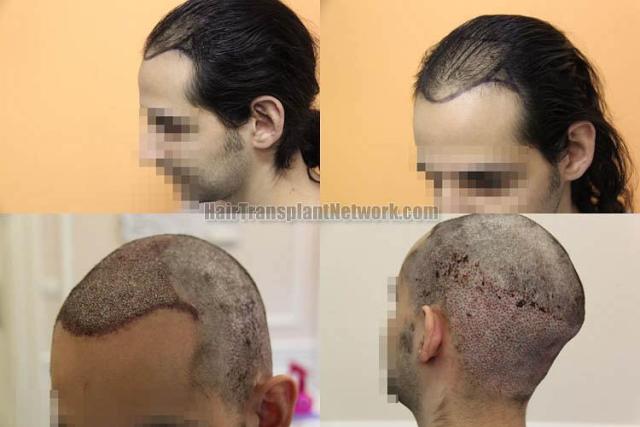 Hair transplantation surgery before and after photos