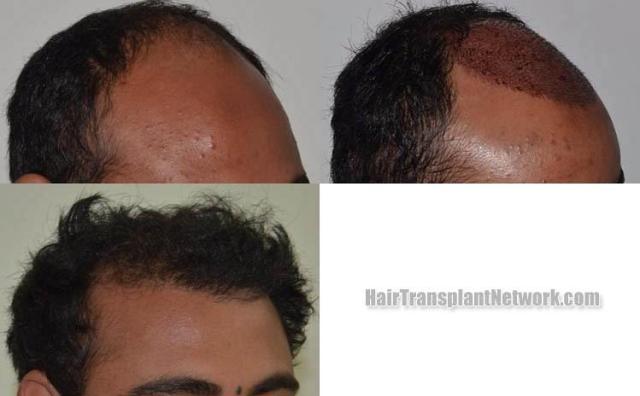 Hair transplantation surgery before and after photos