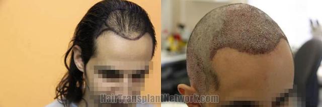 Hair restoration procedure before and after pictures