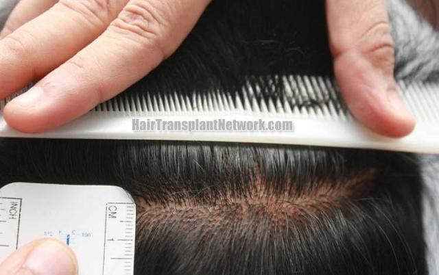 Surgical hair transplantation result photographs