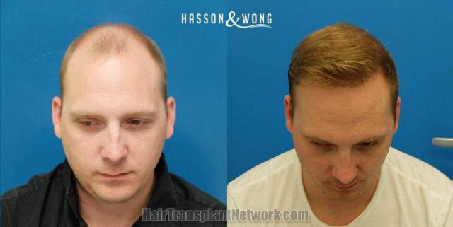 Hair transplantation surgery before and after pictures