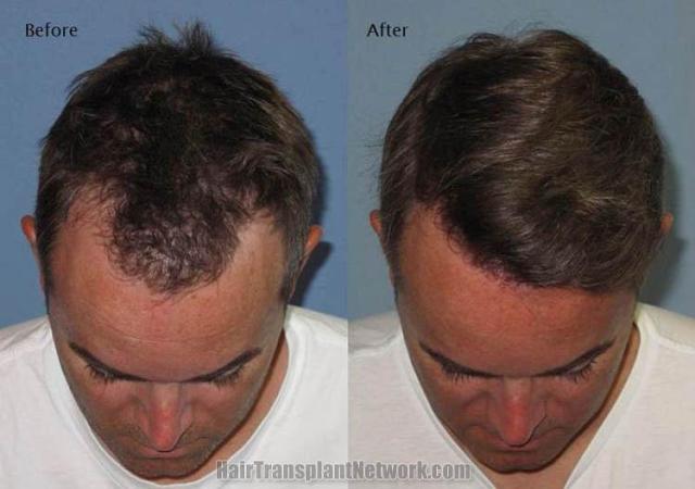 Hair restoration procedure before and after results