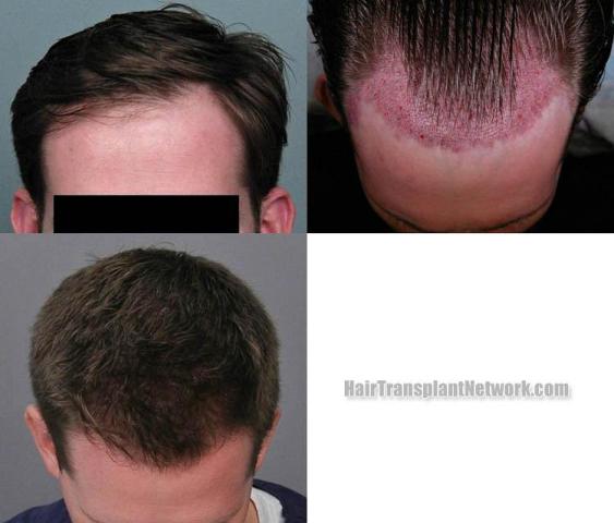 Hair transplantation surgery before and after photos