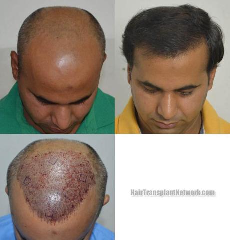 Hair transplantation surgery before and after images