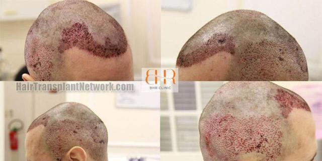 Surgical hair transplantation result photographs