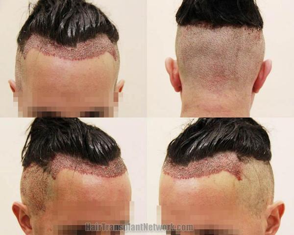 Surgical hair transplantation result photographs