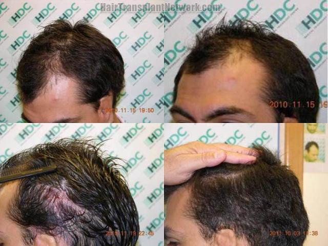 Hair replacement surgery before and after images