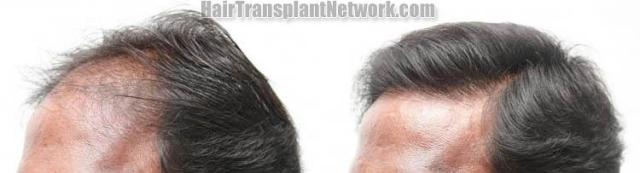 Hair restoration procedure before and after results