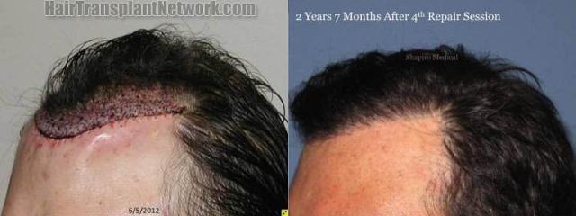 Hair transplantation surgery before and after pictures