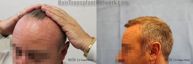 Hair transplantation surgery before and after images