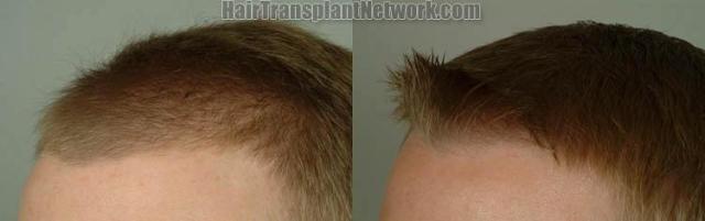 Hair restoration procedure before and after pictures