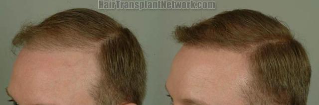 Hair transplantation surgery before and after images