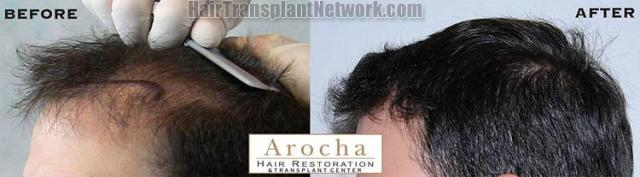 Hair transplantation surgery before and after pictures