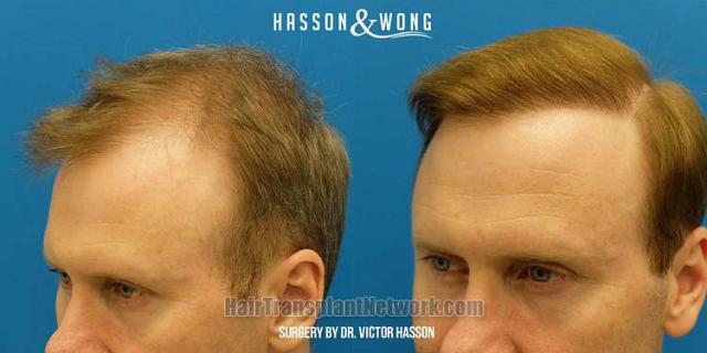 Hair transplantation surgery before and after images