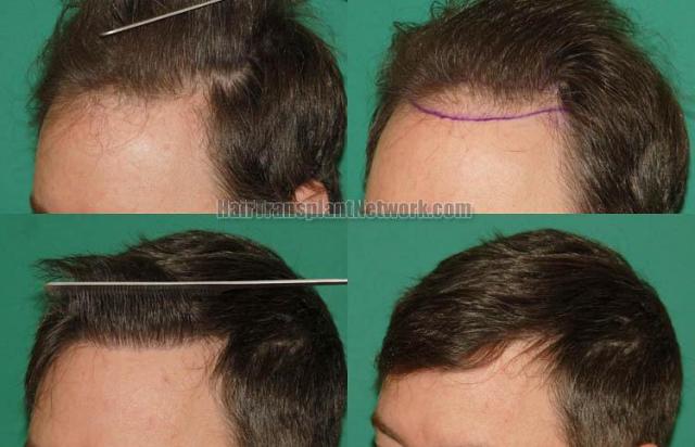 Hair transplantation surgery before and after pictures