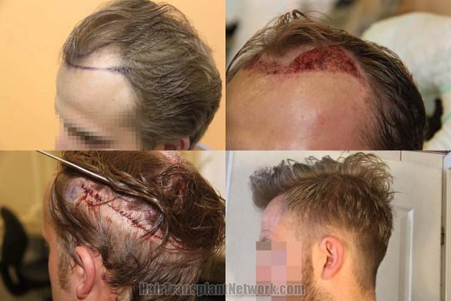 Hair transplantation surgery before and after pictures