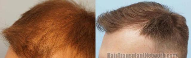 Hair transplantation surgery procedure before and after photos