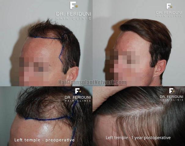 Hair transplantation surgery before and after photos