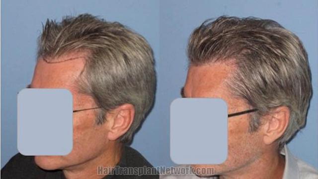 Hair restoration procedure before and after pictures