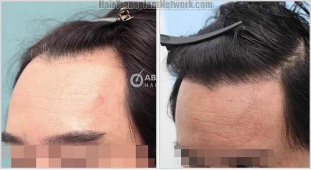 Hair transplantation surgery before and after photos