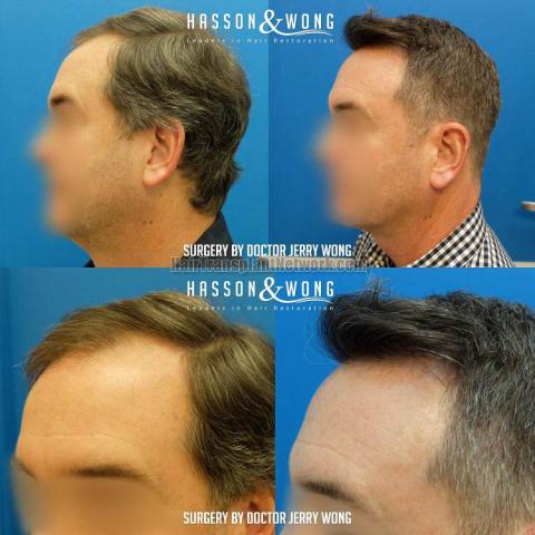 Hair transplantation surgery before and after photos