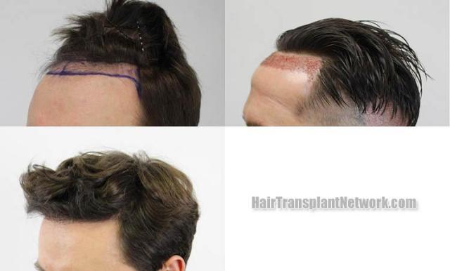 Hair transplantation surgery before and after images