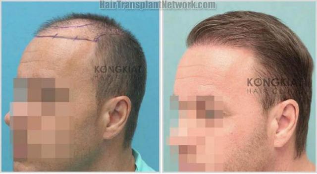 Hair transplantation surgery before and after photos