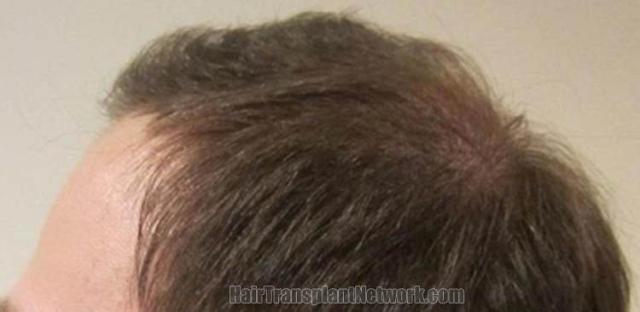 Hair transplantation surgery before and after pictures