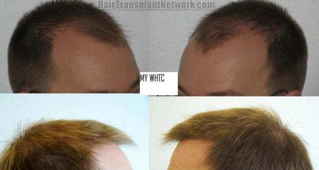 Hair transplantation surgery before and after photos