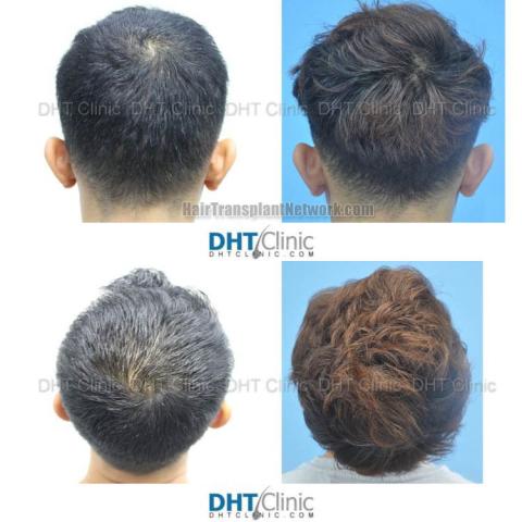 Surgical hair transplantation result photographs