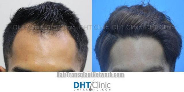  Before and after hair restoration procedure