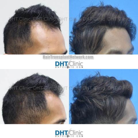 Hair transplantation procedure before and after results