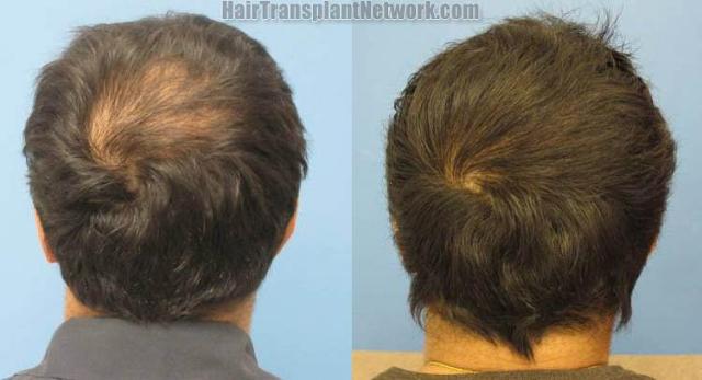 Back view - Before and after hair replacement surgery