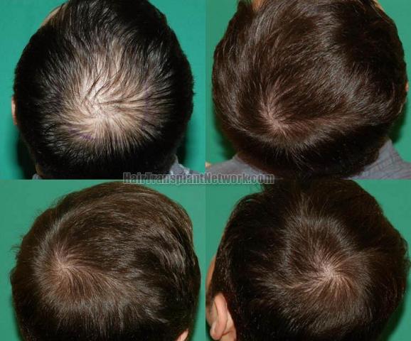 Hair transplantation surgery before and after photos