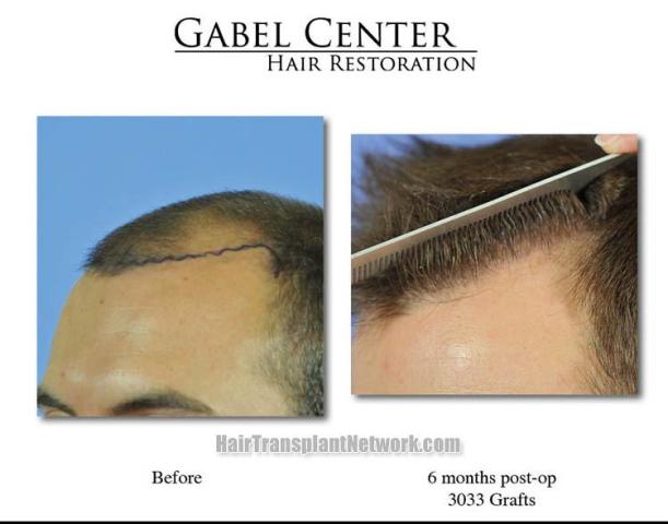 Hair transplantation surgery before and after images