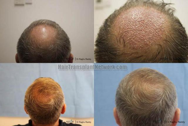 Hair transplantation surgery before and after pictures