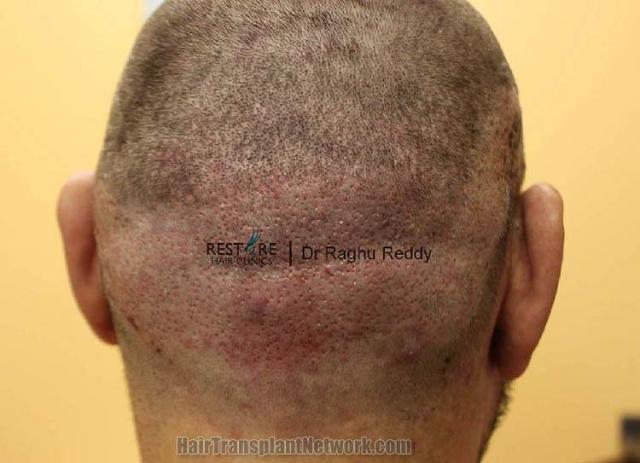 Hair transplantation surgery before and after pictures